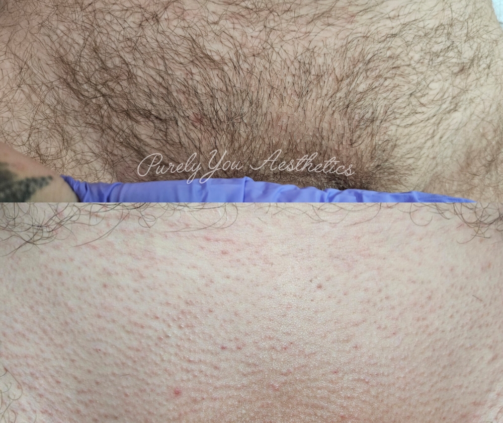 (P) Brazilian/Bikini Wax