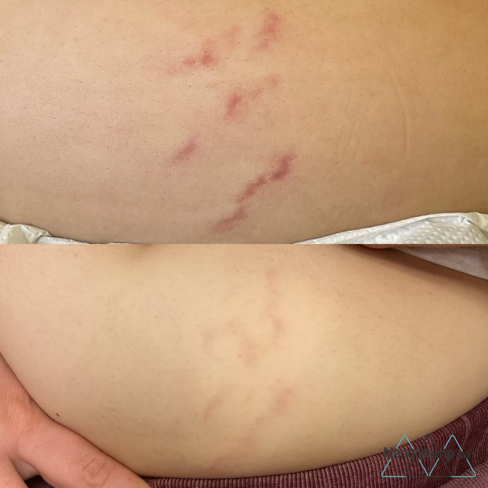 Stretch Marks