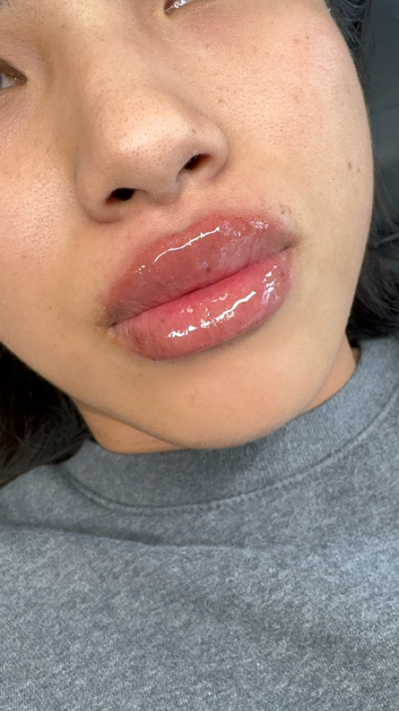 1ML Lip Filler