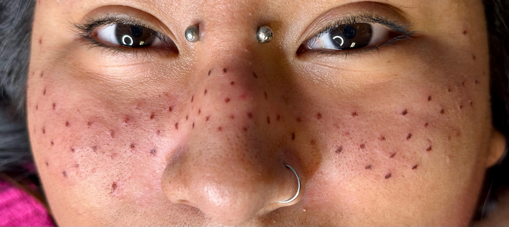 Tattoo Freckles