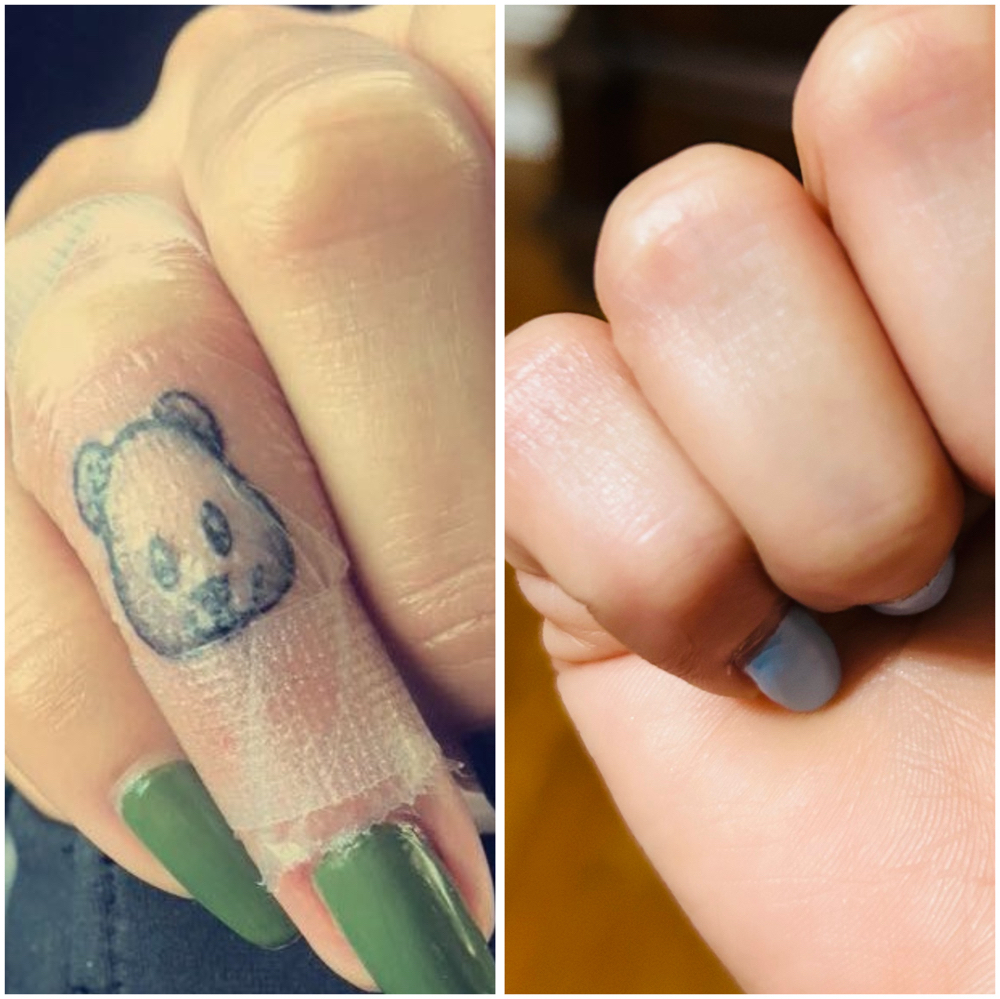 Tattoo Removal