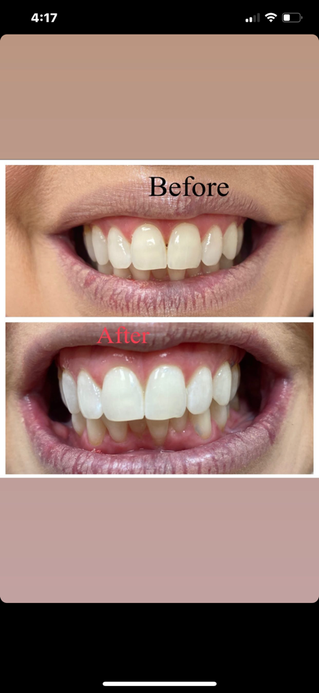 Teeth Whitening 1 Session