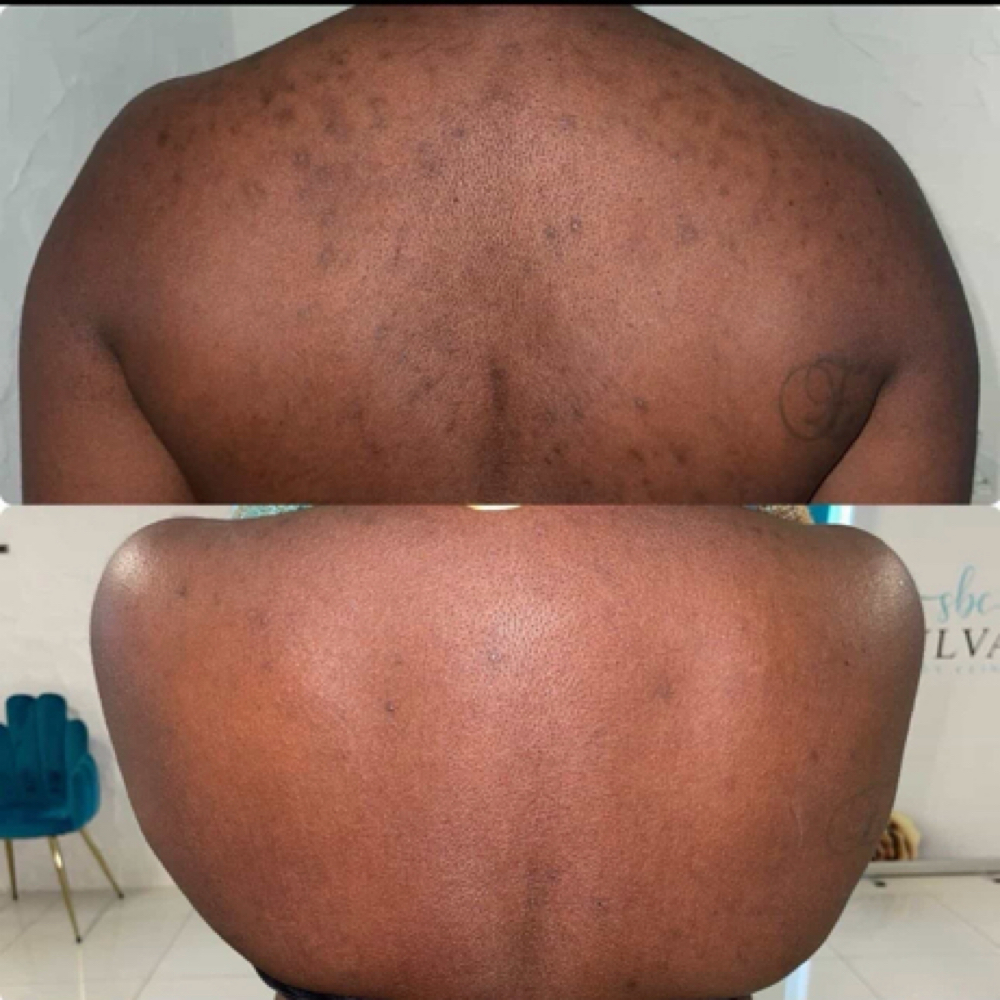 BYE BYE BACNE PEEL at Lumiére Skin Science in Atlanta, GA