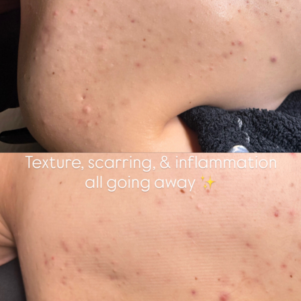 BACK ACNE CONSULTATION + TREATMENT at Lashes+corrective skincare+waxing+brows in Temecula, CA
