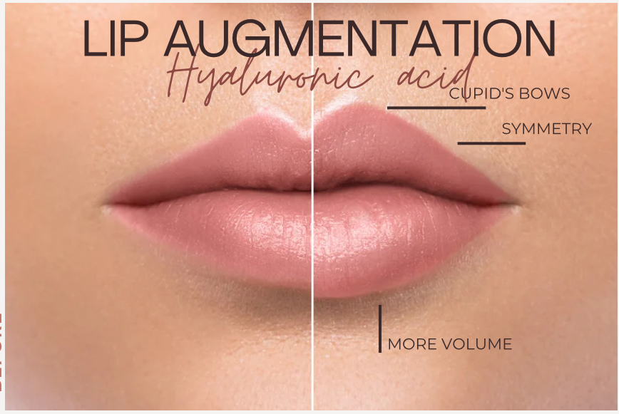 Enhanced Lip Fillers