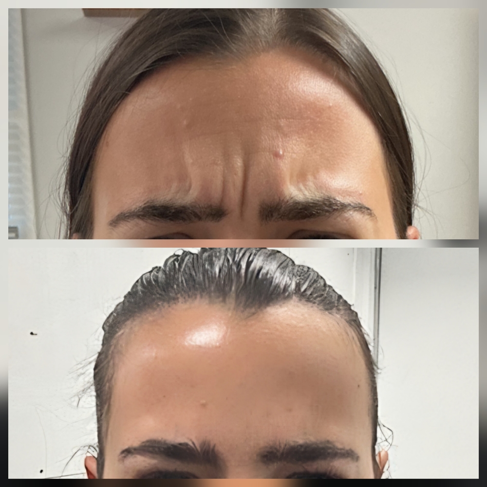 Xeomin - Tox Injections