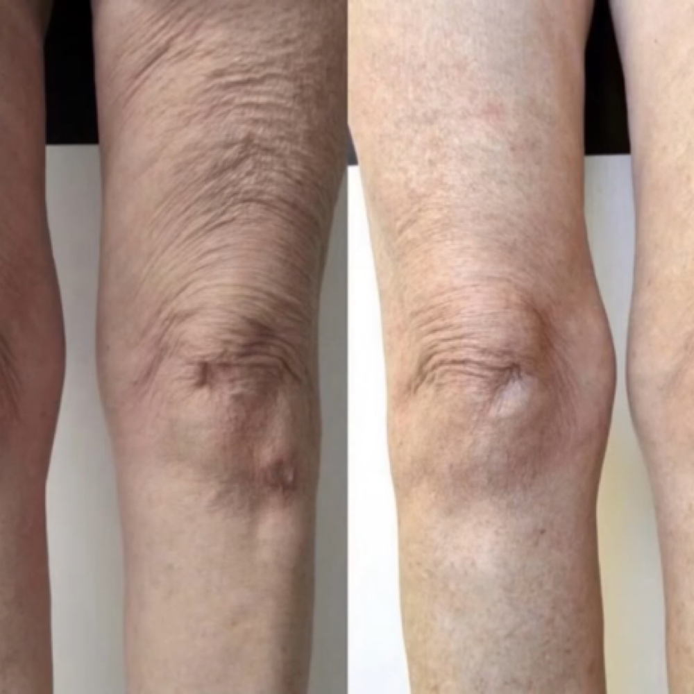 RF Skin Tightening at Advanced Aesthetics & Lash Studio in Salem, OR
