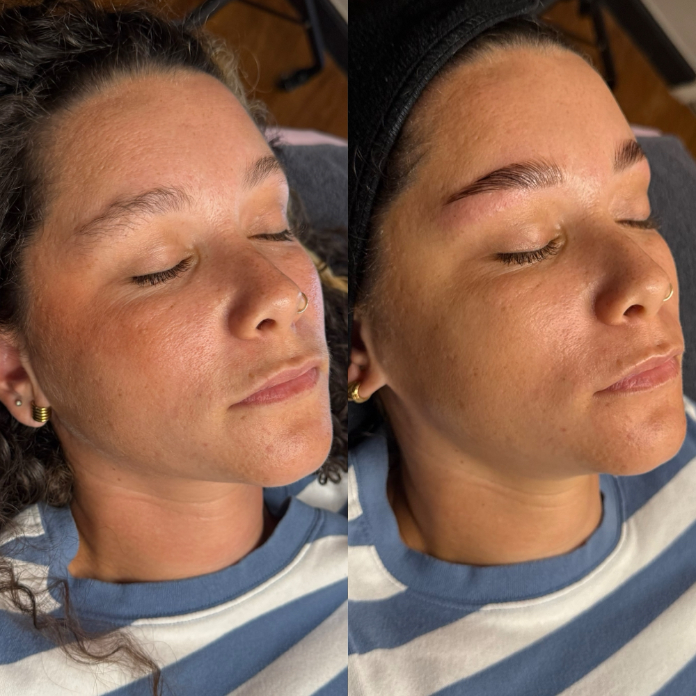 Dermaplane Glow Facial at solshine beauty in Fort Myers, FL