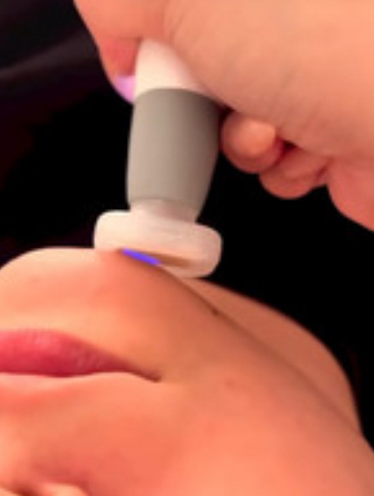 Jet Plasma Treatment