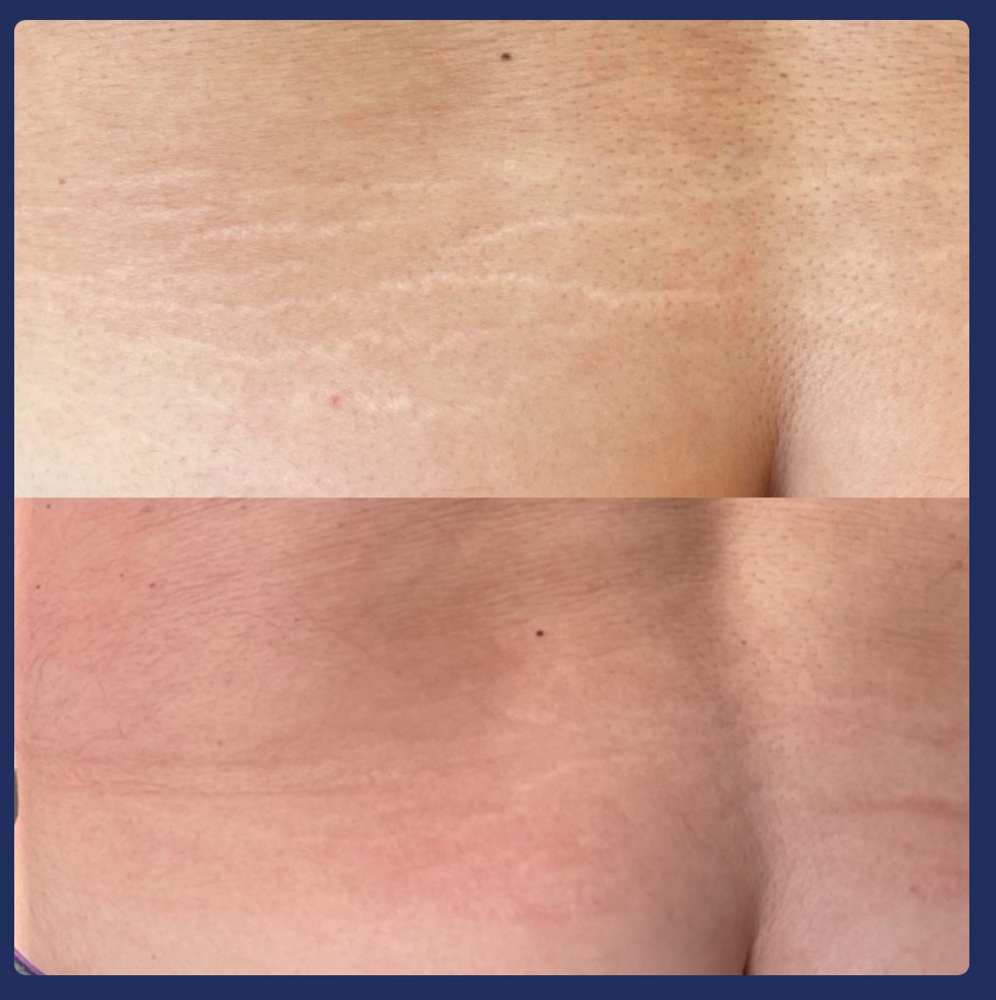 Inkless Stretch Mark Revision