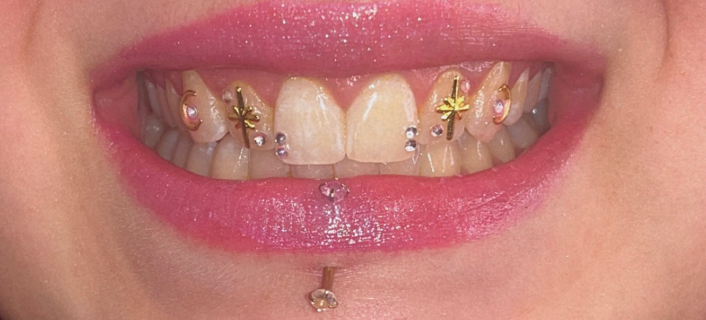 Tooth Gemming