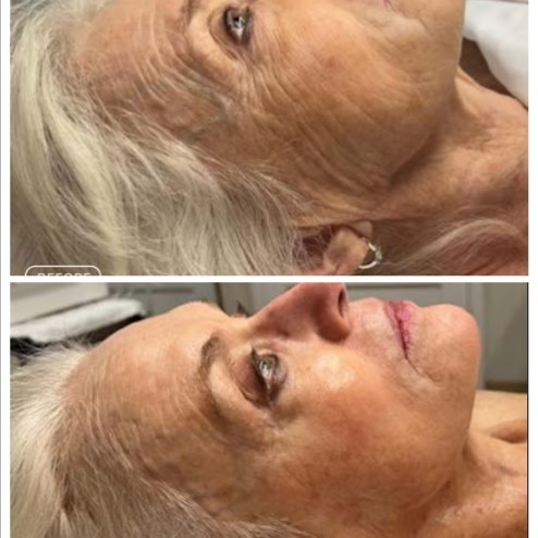 Anti-Aging Bundle at Premier Clinical Aesthetics in Ocala, FL