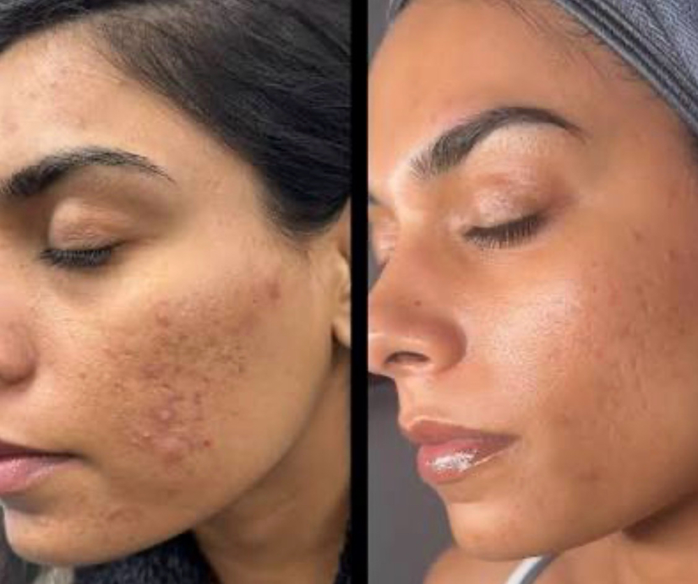 Peel N Glow ✨💕 at Maurika Beauty in Jacksonville, FL