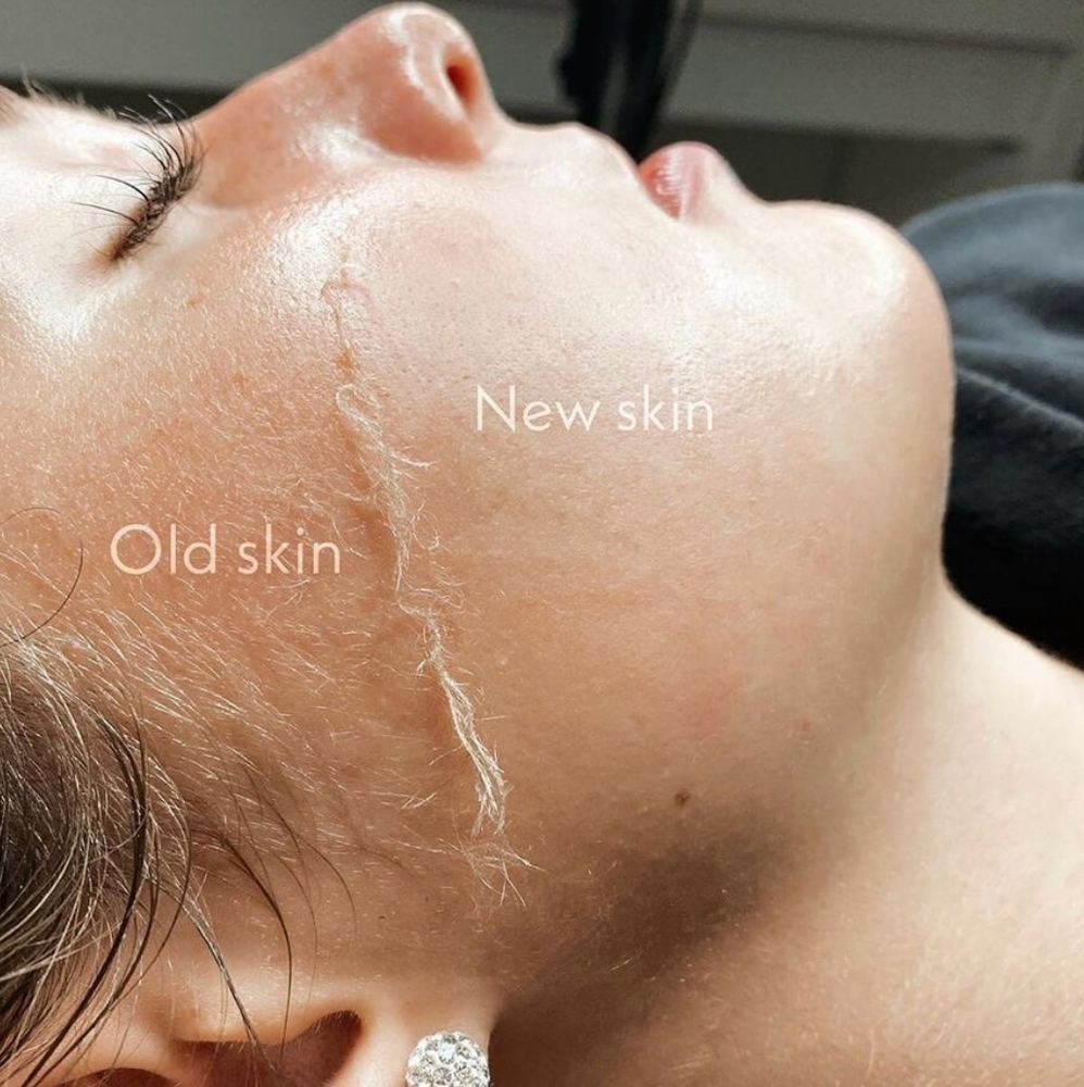 Dry Dermaplane