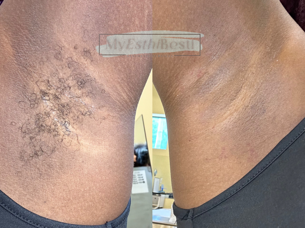 Underarm Wax