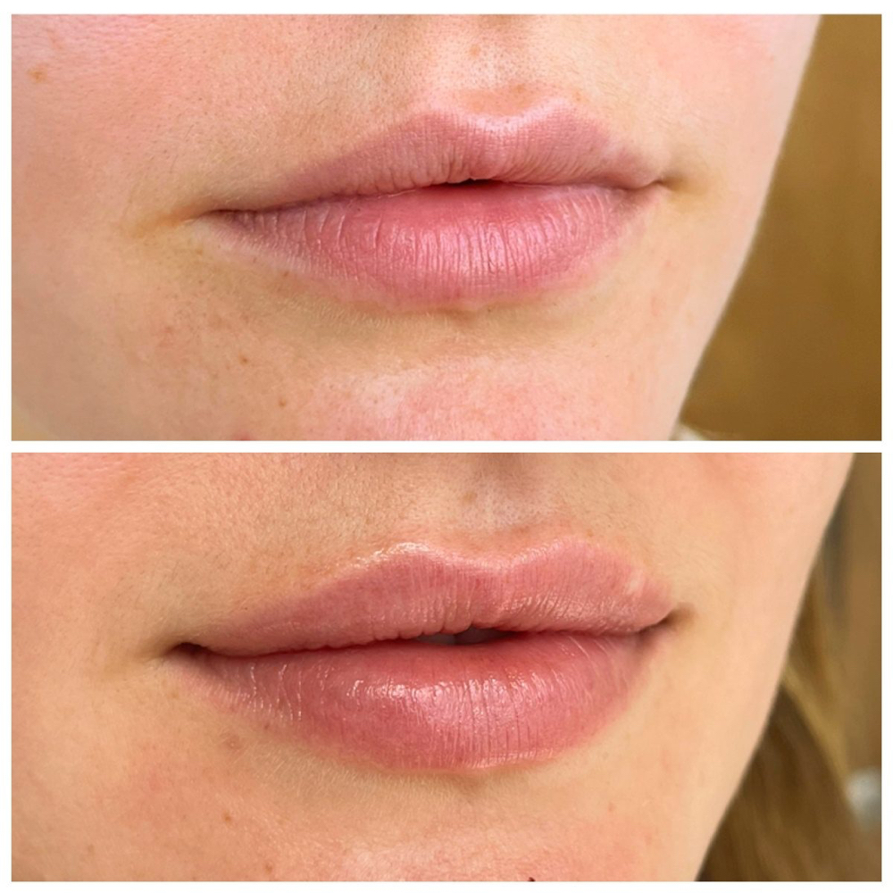 LIP FILLER - Half Syringe