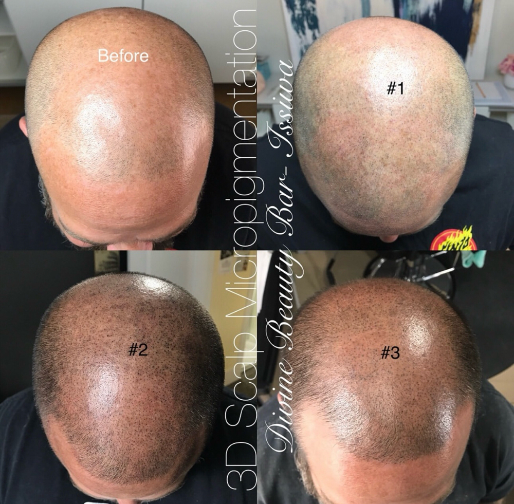 Scalp Micropigmentation SMP