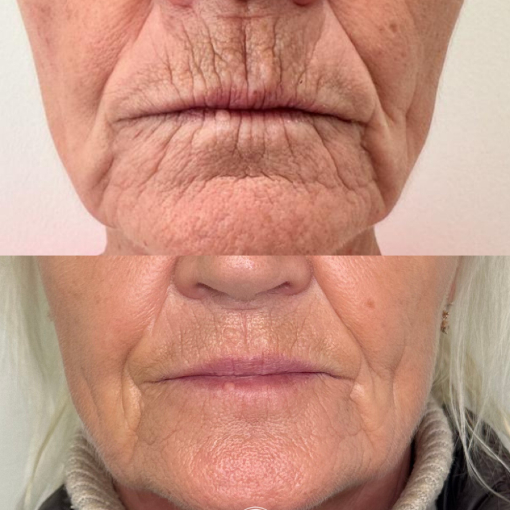 Perioral Lines Dermal Filler at Monroe’s Everlasting Beauty in Corpus Christi, TX