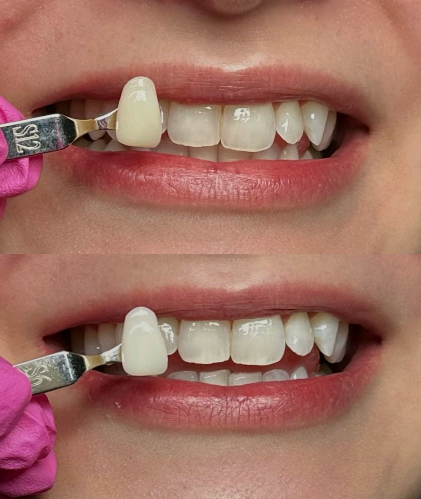 Teeth Whitening