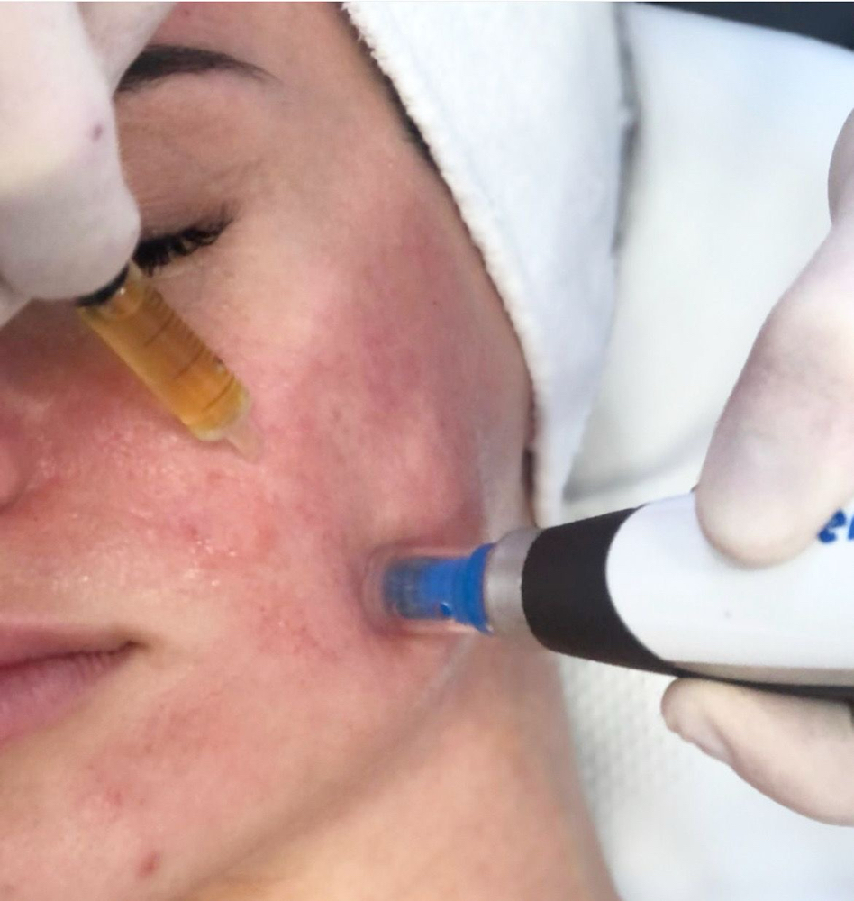 Bio-Boost Facial at Zoraya Velez AESTHETICIAN in Richmond, VA