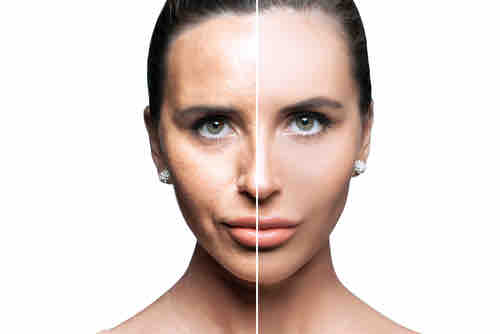 Procell Microchanneling