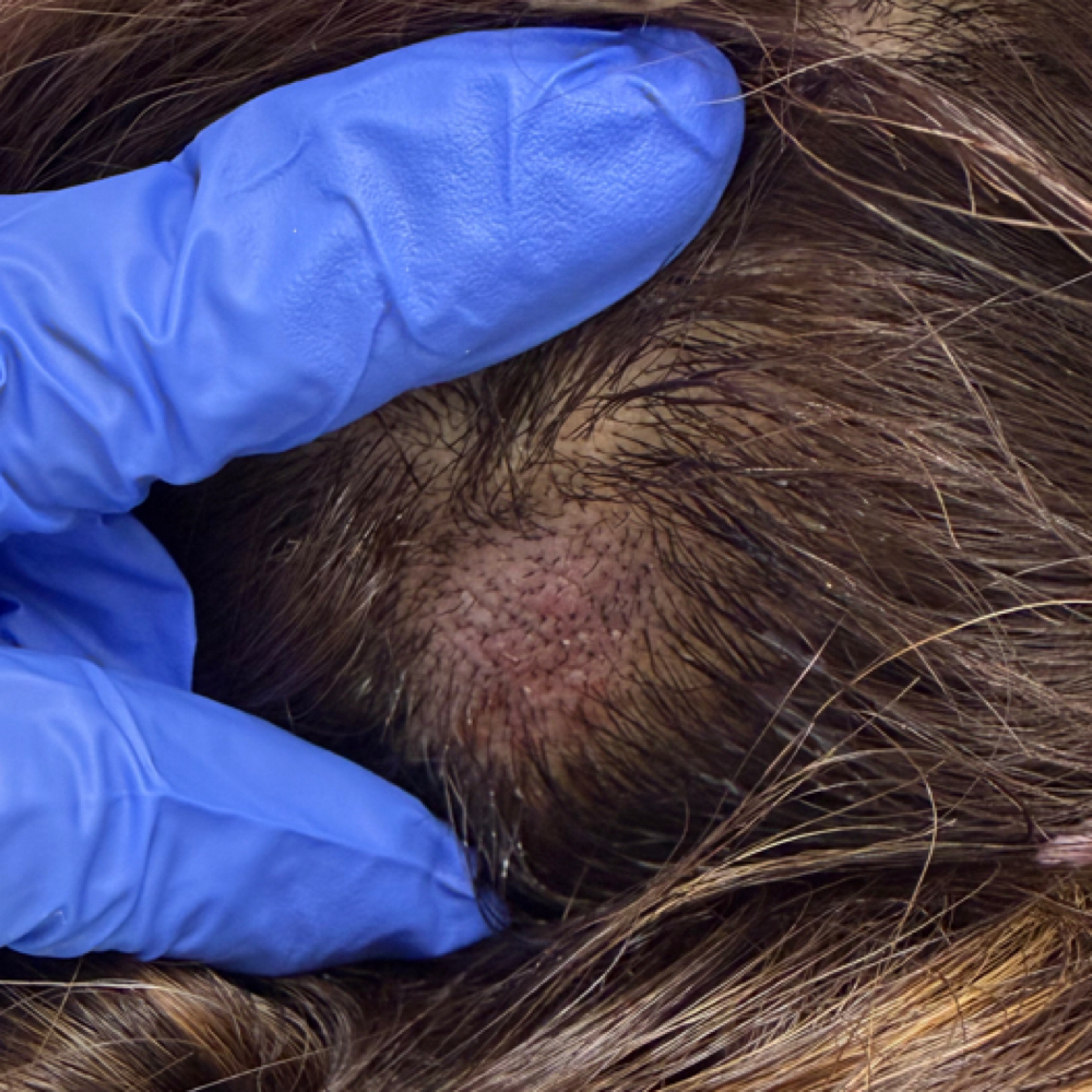 HYDRAFACIAL™ Keravive Hair at Unmasked Aesthetics in Vancouver, WA