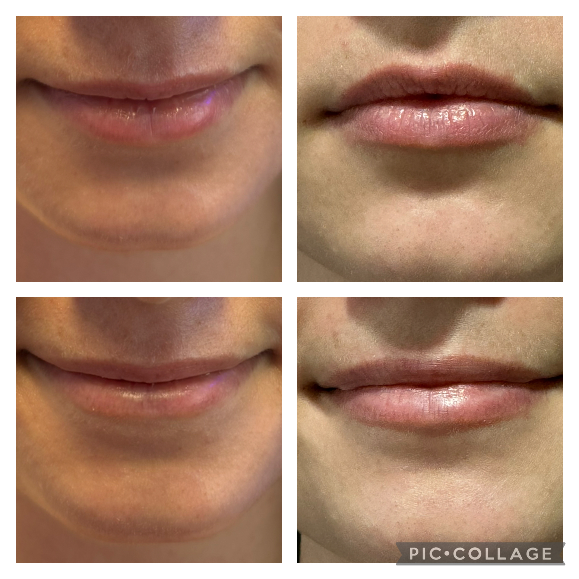 Botox Lip Flip