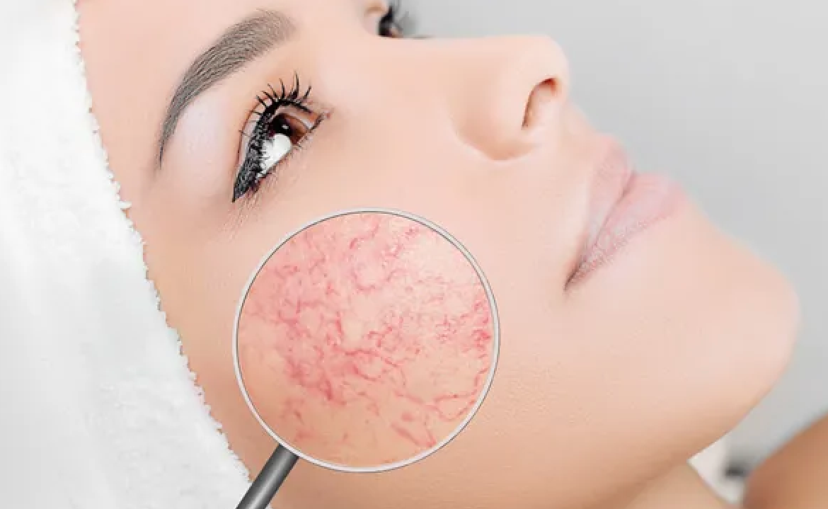 VeinGogh Facial
