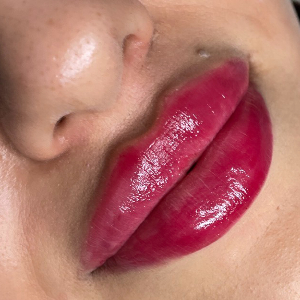Lip Filler 1ML at Gold Stone Beauty in mcallen, TX