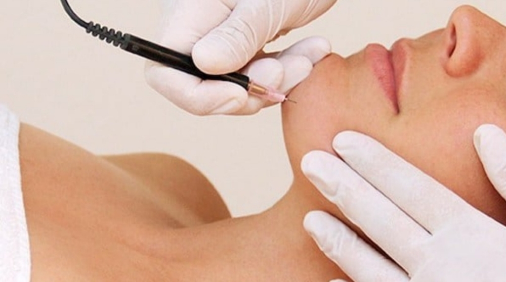 Electrolysis (Price Is Per Hour)