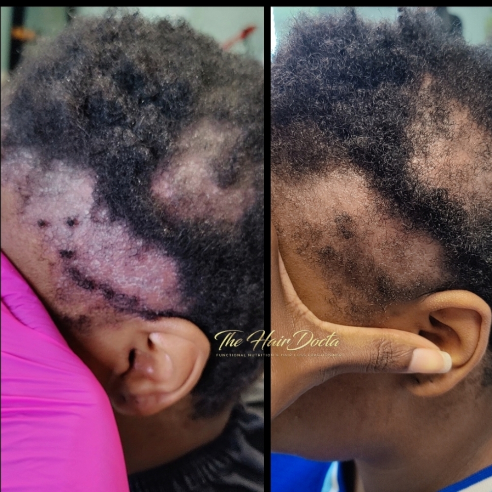 🔥 Scalp Inflammation Therapy at The Hairdocta Clinic in Kansas City, MO