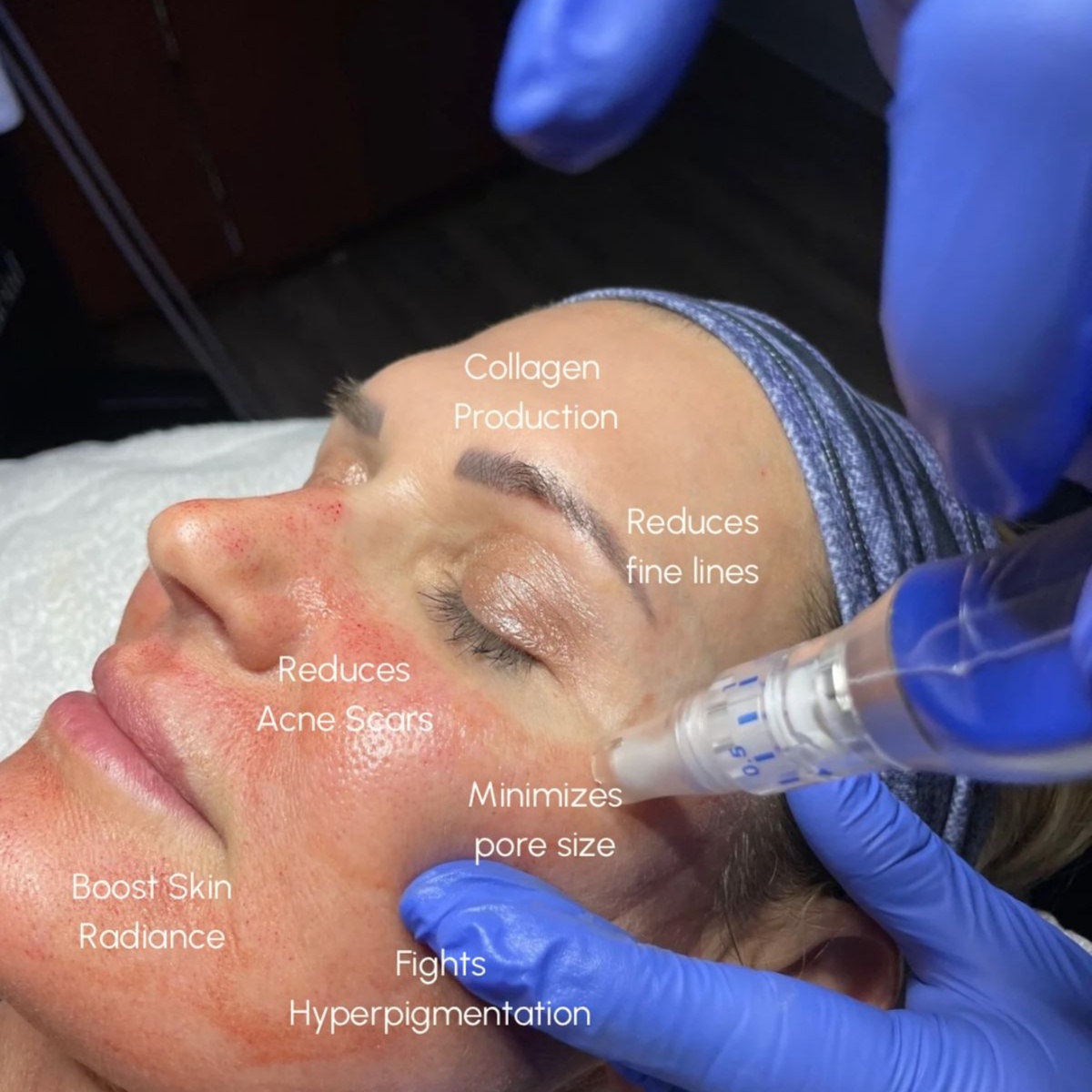 DERMAPEN + MULTIPEPTIDOS ESPECIAL at Lumiee Skincare Llc in Chicago, IL