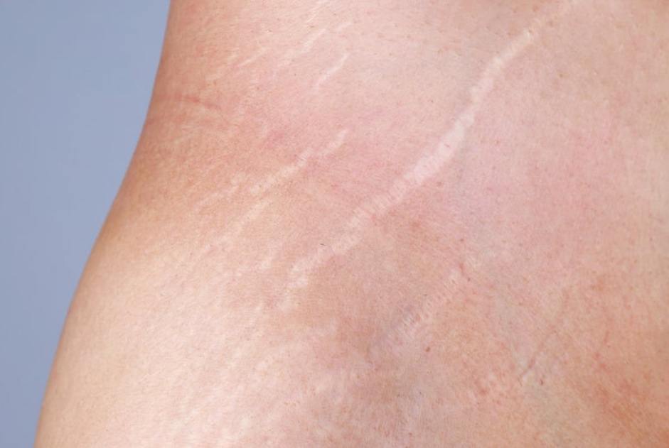 Whole Body Stretchmark Camouflage