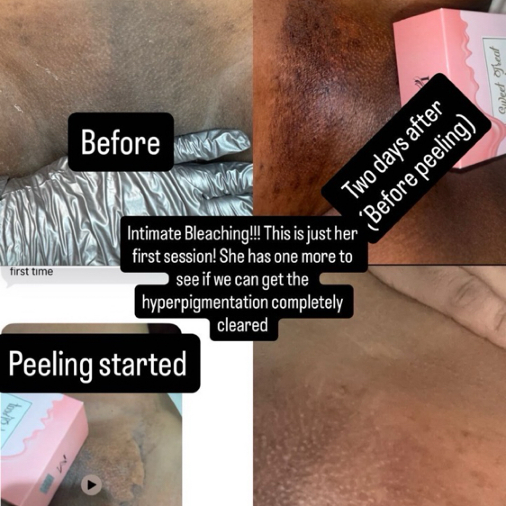 Intimate Bleaching Treatment at Thee Beaute Blender in Shreveport, LA