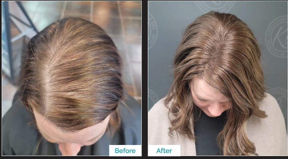 Hair Replacement Installation