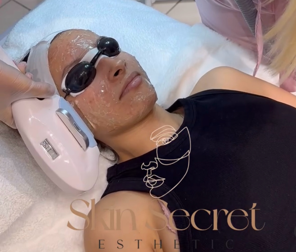 IPL (laser) Secuelas De Acne