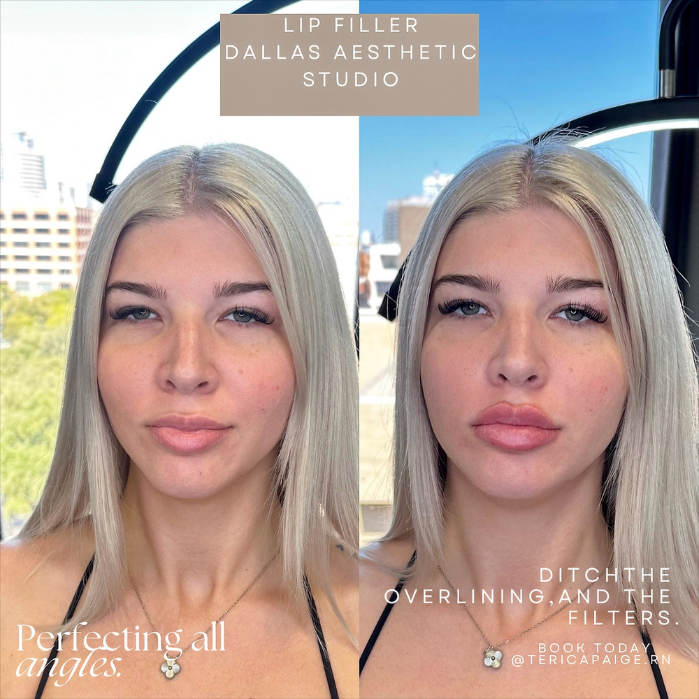 Lip Filler Full Syringe at Dallas Aesthetic Studio in Dallas, TX