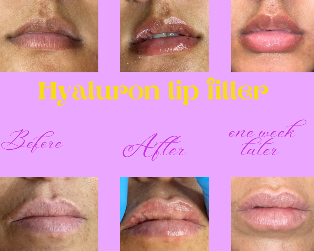 Hyaluron Lip Filler 1ml