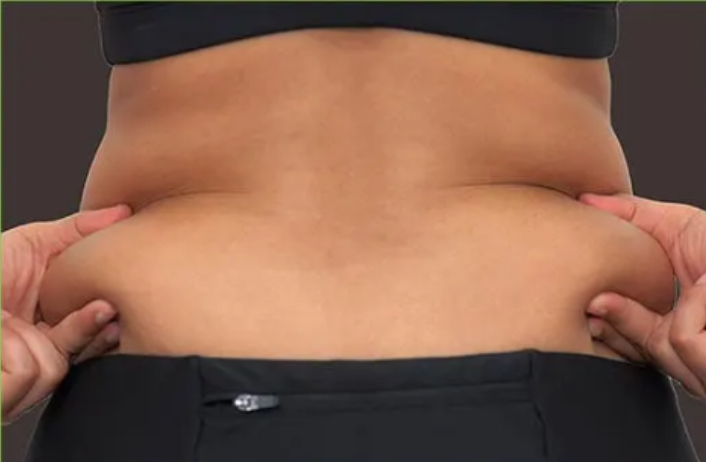Fat Dissolve Back Rolls