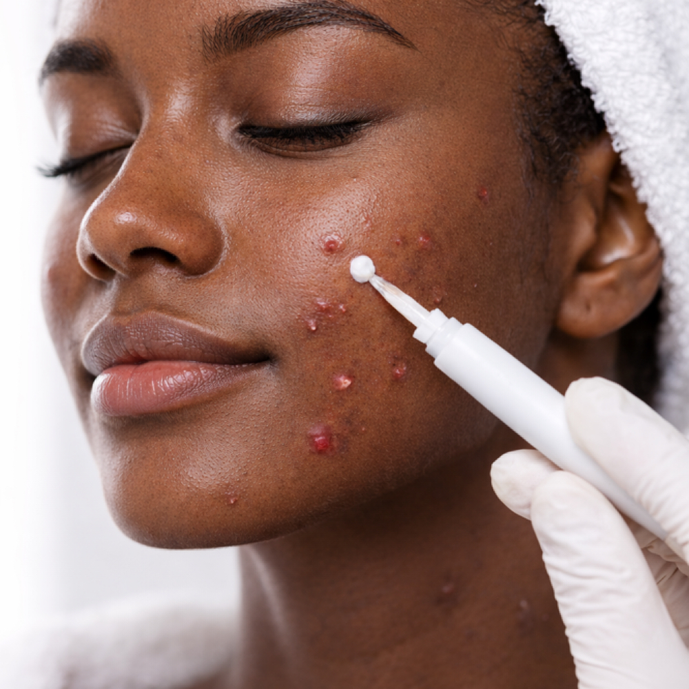 Acne Eliminator at Healing Hands by Karen in Providence, RI