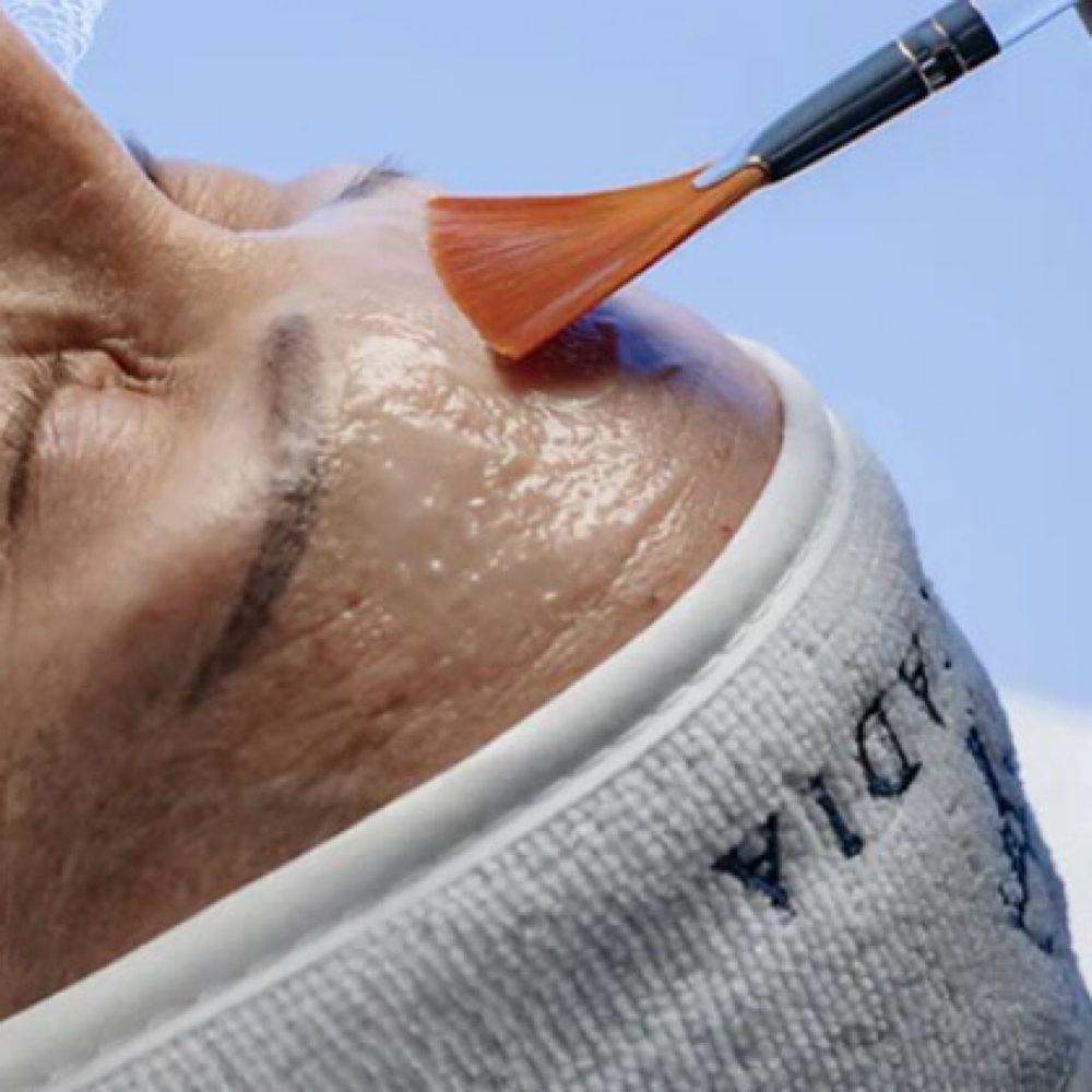 SWiCH Renewal at On Point Esthetics in Thibodaux, LA