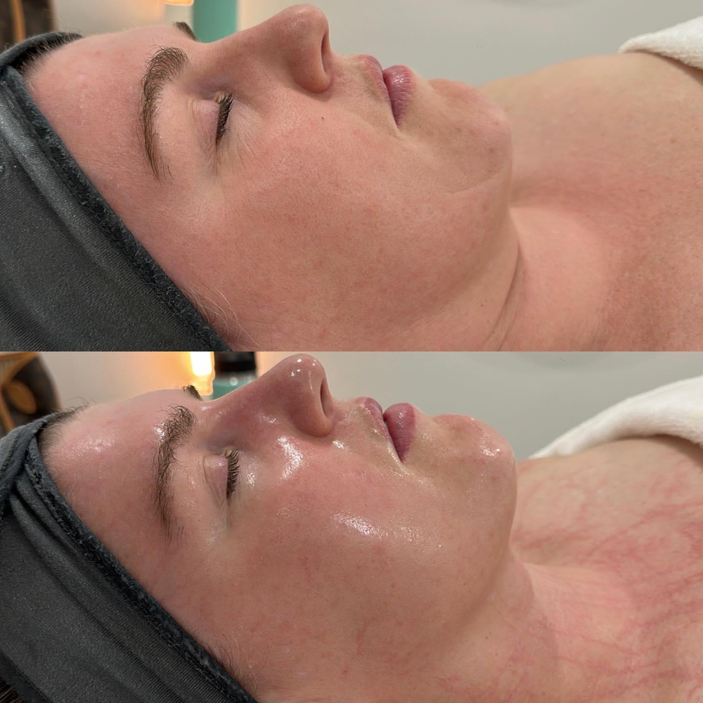 Enzyme Therapy Facial