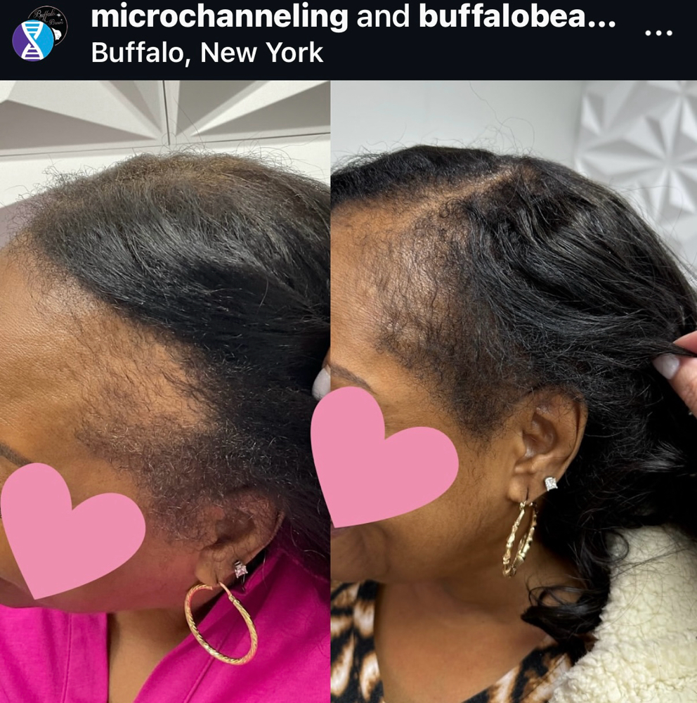 Hair Restoration (Partial Scalp)