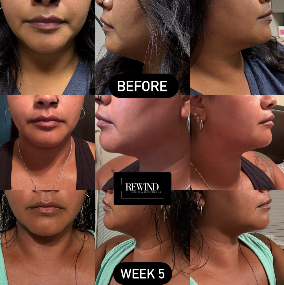 Double Chin Treatment đź’‰ at Rewind Health & Aesthetics LLC in San Marcos, TX