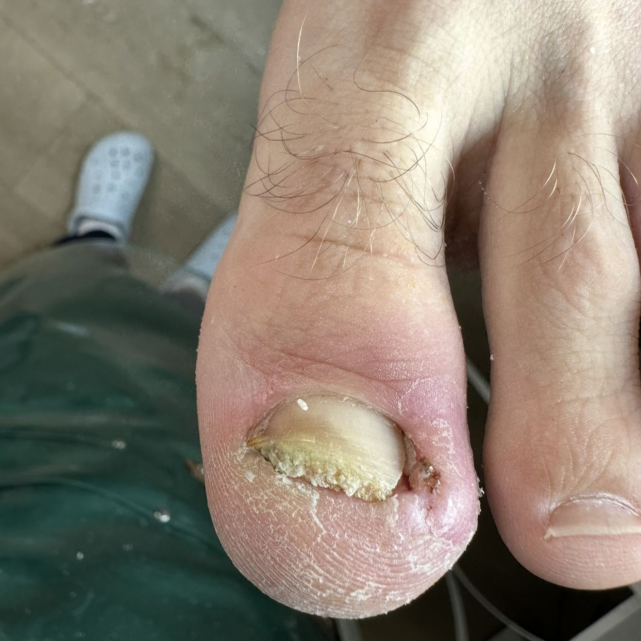 Complex Toenail Care 2nd Category