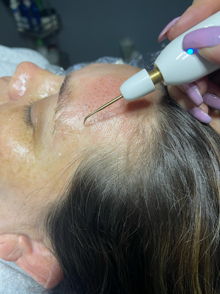 Fibroblast Skin Tightening Consult