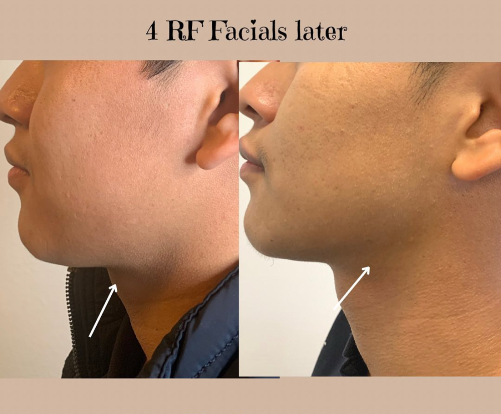 RF facial lift & Neck Treatment