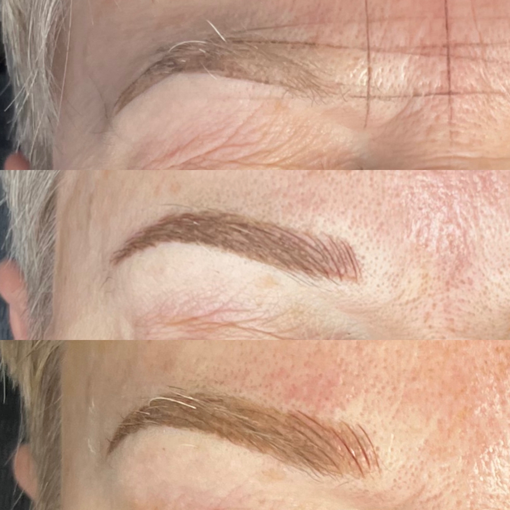 Brow Correction