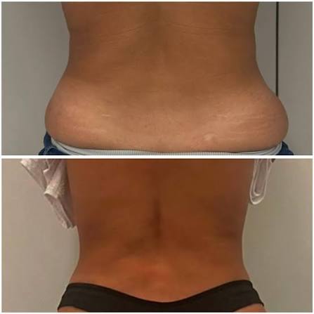 Facials - Back Facial at Natural Glow in Grand Praire, TX