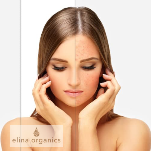 Redness & Rosacea Relief